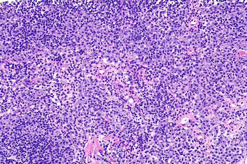 Multiple myeloma slide with intermediate magnification[23]
