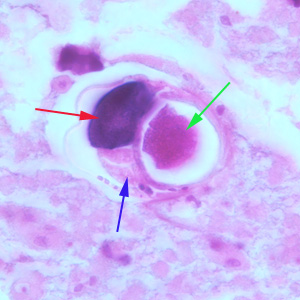 Higher magnification (1000x oil) of a gravid female of S. stercoralis from the same specimen as Figure 1. Notice the intestine (blue arrow), ovary (red arrow) and an egg within the uterus (green arrow). Adapted from CDC