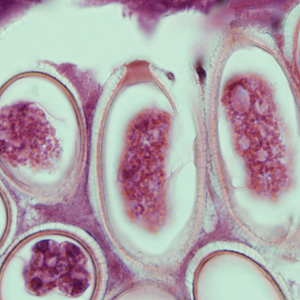 Eggs of C. hepatica in liver stained with hematoxylin and eosin (H&E). The egg in this figure (1000x magnification) shows the typically striated shell and shallow polar prominences. Adapted from CDC
