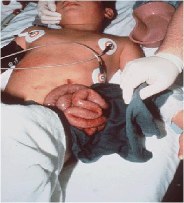 Evisceration: Extrusion of abdominal contents secondary to penetrating abdominal trauma