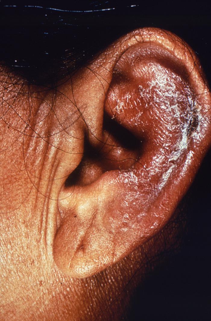Tuberculoid or paucibacillary leprosy with inflammatory lesion on the outer left ear. Adapted from Public Health Image Library (PHIL), Centers for Disease Control and Prevention.[6]