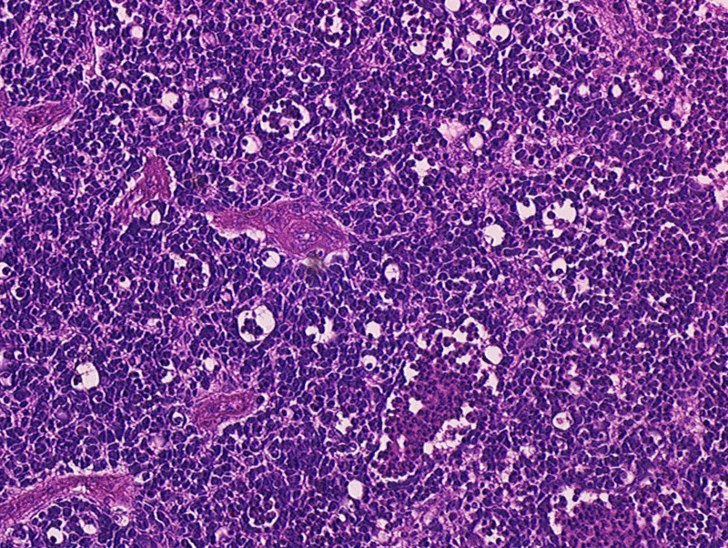 Retinoblastoma 400 X magnification[13]