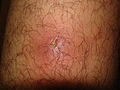 Boil(furuncle) on Anterior leg: Dome shaped pus filled boil(furuncle) with erythema of skin - By The original uploader was Mahdouch at French Wikipedia - Transferred from fr.wikipedia to Commons., CC BY 1.0, https://commons.wikimedia.org/w/index.php?curid=3123389