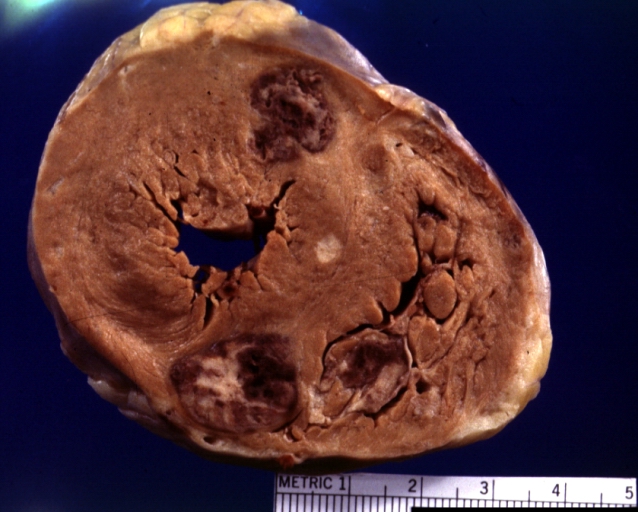 HEART: Metastatic Carcinoma: Gross fixed tissue, color, large lesions, primer is renal cell carcinoma.