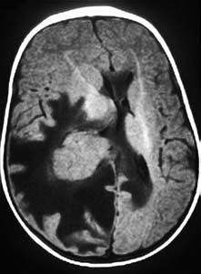 Choroid plexus papilloma (CPP). This 9 month old child presented with a history of lethargy. T1 weighted axial MRI reveals an intermediate signal mass in the lateral ventricle. T1 weighted axial MRI after gadolinium shows intense, homogeneous enhancement of the mass in the lateral ventricle.