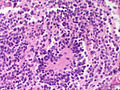 Adrenal neuroblastoma[12]