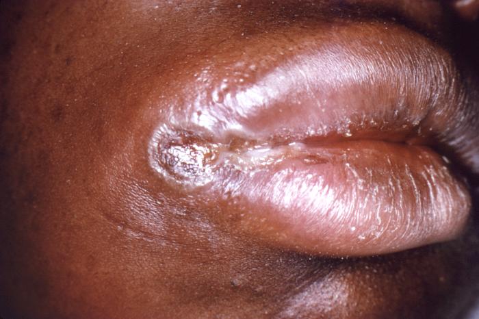 This image depicts a close view of the right corner, i.e., angle, of the mouth of an African-American female, upon which one can see a circular lesion that was diagnosed as a primary syphilitic chancre. The primary stage of syphilis is usually marked by the appearance of a single sore (called a chancre), but there may be multiple sores. The time between infection with syphilis and the start of the first symptom can range from 10 to 90 days (average 21 days). The chancre is usually firm, round, small, and painless. It appears at the spot where syphilis entered the body. The chancre lasts 3 to 6 weeks, and it heals without treatment. However, if adequate treatment is not administered, the infection progresses to the secondary stage. Adapted from CDC