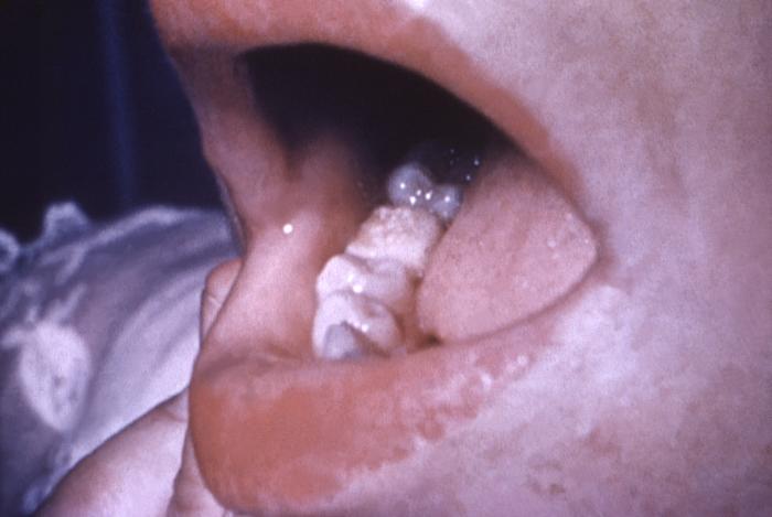 This image depicts the dentition of a congenital syphilis patient, who due to this disease, went on to develop what are known as mulberry molars. “Moon's", or mulberry molars, is a condition where the bite surface of the permanent first lower molar teeth develops rounded surfaces to its cusps, resembling the surface of a mulberry. Congenital syphilis, is a condition caused by infection in utero with Treponema pallidum. A wide spectrum of severity exists, and only severe cases are clinically apparent at birth. An infant or child (aged less than 2 years) may have signs such as hepatosplenomegaly, rash, condyloma lata, snuffles, jaundice (nonviral hepatitis), pseudoparalysis, anemia, or edema (nephrotic syndrome and/or malnutrition). An older child may have stigmata (e.g., interstitial keratitis, nerve deafness, anterior bowing of shins, frontal bossing, mulberry molars, Hutchinson teeth, saddle nose, rhagades, or Clutton joints). Adapted from CDC