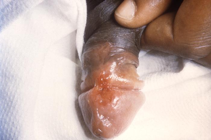 This patient presented with a primary syphilitic chancre on the ventral side of the penile glans and shaft. The primary stage of syphilis is usually marked by the appearance of a sore called a chancre. The chancre is usually firm, round, small, and painless. It appears at the spot where syphilis entered the body, and lasts 3-6 weeks, healing by itself. Adapted from CDC