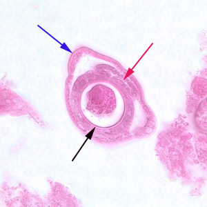 Cross-section of a gravid adult female C. philippinensis from an intestinal biopsy specimen, stained with H&E. Shown in this figure are a bacillary band (blue arrow), the intestine (red arrow) and uterus containing an egg in cross-section (black arrow). Adapted from CDC