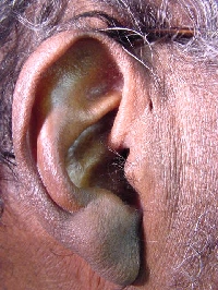 Pre-auricular cysts connect to the outside with a sinus tract that opens into a pit, just anterior to the root of the helix. Occasionally, foul smelling material oozes out of the pit.[1]