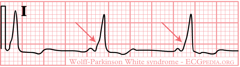 The upstroke of the QRS-complex is 'slurred', resulting in a delta-wave (arrow).