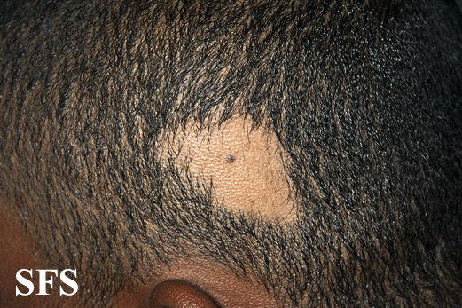Alopecia acquisitum centrifugum. Adapted from Dermatology Atlas.[1]