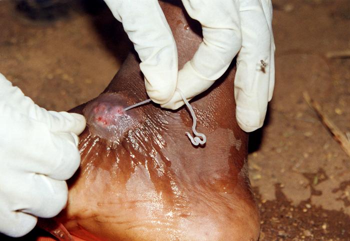 This image depicts the subcutaneous emergence of a female Guinea worm, Dracunculus medinensis, from a sufferer’s lower left leg. From Public Health Image Library (PHIL). [8]