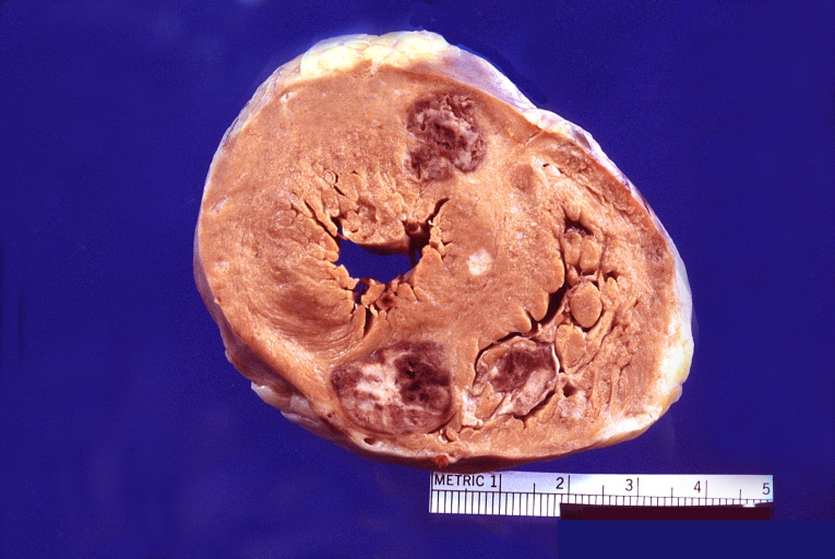 Heart metastases from bronchogenic carcinoma