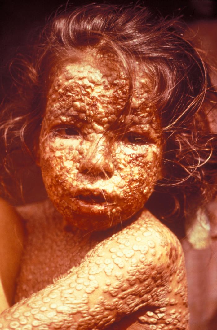 A young Bangladeshi girl infected with smallpox (1973). Thanks to the development of the smallpox vaccine, the disease was officially eradicated in 1979.
