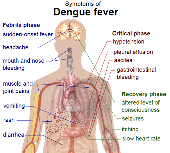 File:Symptoms Dengue Fever.png
