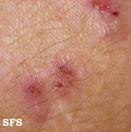 File:Dermatitis herpetiformis02.jpg