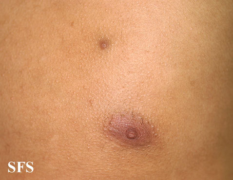 . Nipples supernumeraryAdapted from Dermatology Atlas.[4]