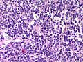 File:120px-Adrenal Neuroblastoma MP CTR.jpg