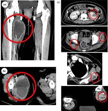 Computed tomography with contrast enhancement in the right thigh on admission (a,b). Frontal slice (a). Mid-femoral cross sectional slice (b). Disseminated abscesses throughout the patient's body including the kidney and muscle (c).[21]
