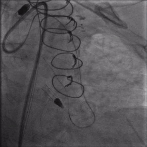 Video 3. Crossing the left main CTO from the retrograde approach with a Pilot 200 wire supported by a Corsair microcatheter (currently being withdrawn).