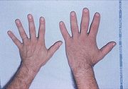 File:Acromegaly hands.JPEG