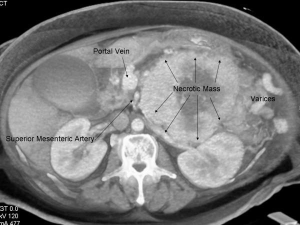 Cross-sectional CT depiction of large necrotic pancreatic VIPoma and its relation to the portal vein and superior mesenteric artery.[2]
