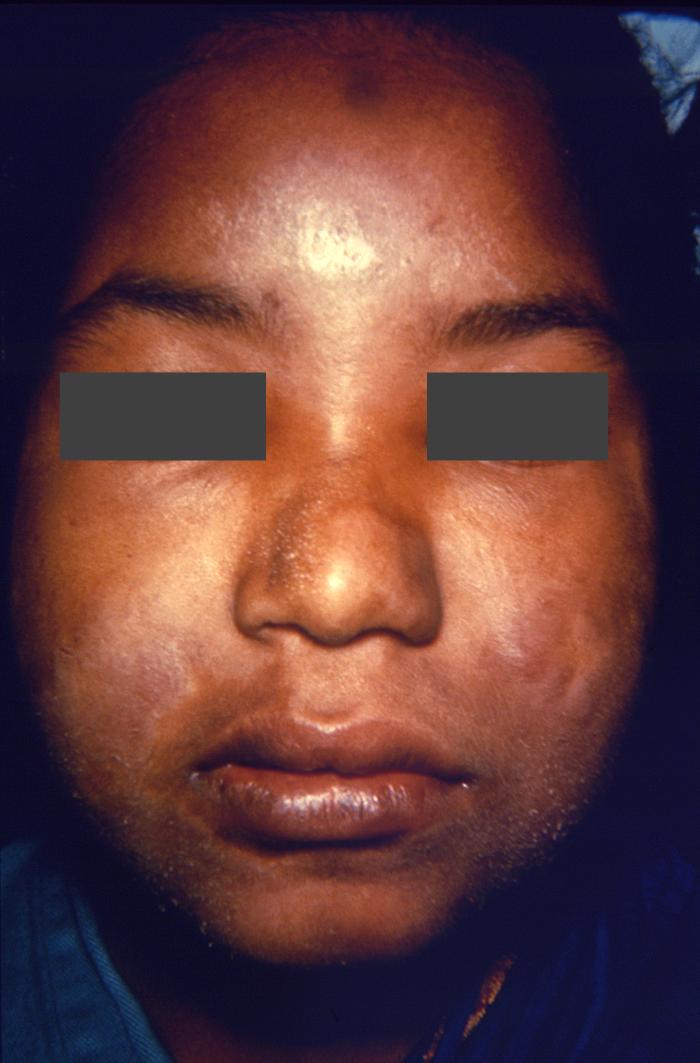 Borderline, or dimorphous leprosy with bilateral involvement of the buccinator muscles, as well as dermatomyositis. See PHIL 15504, for another view of this patient’s face. Adapted from Public Health Image Library (PHIL), Centers for Disease Control and Prevention.[6]