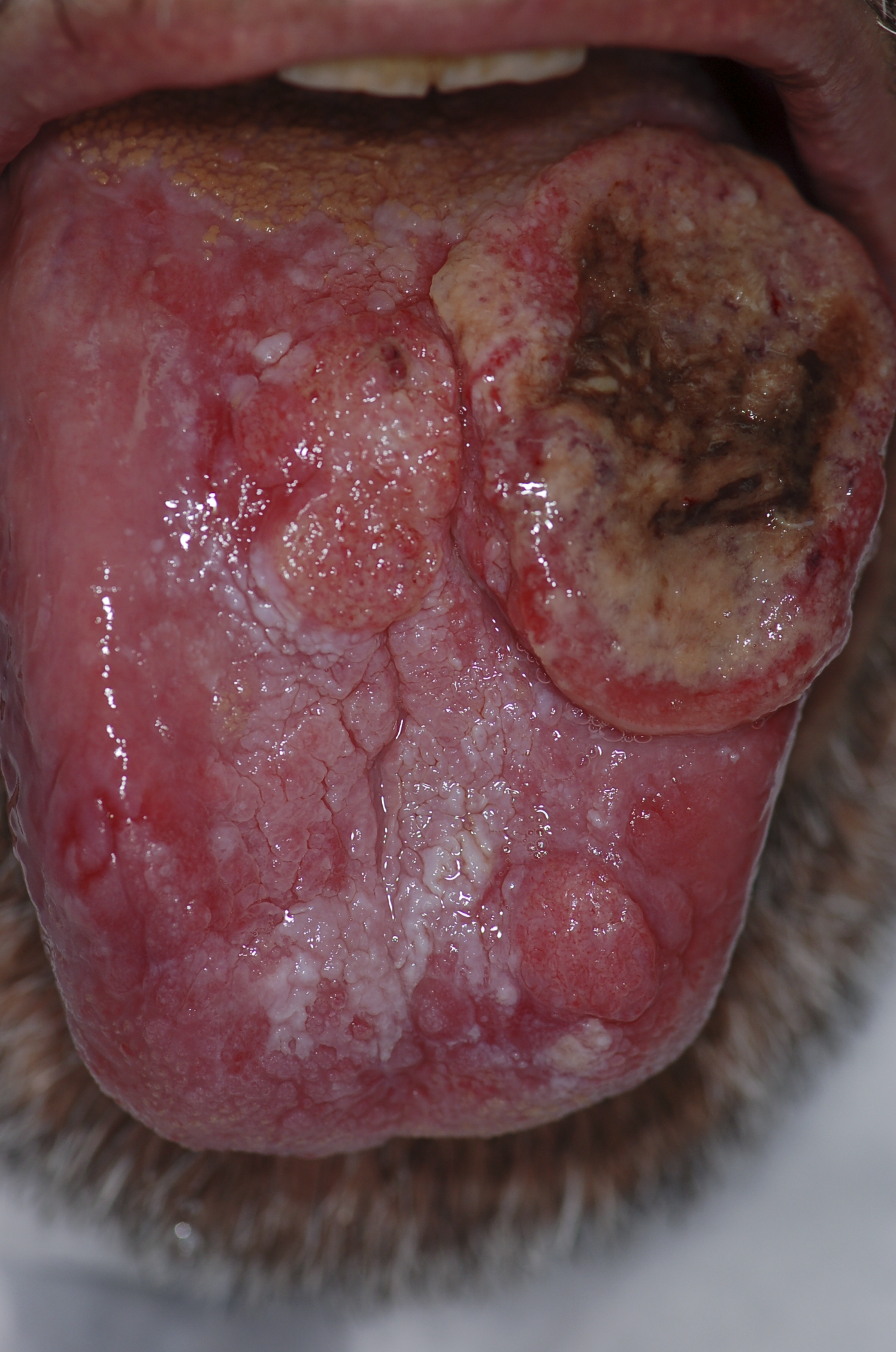 thumb, Gross pathology of oral SCC, source: By Luca Pastore, Maria Luisa Fiorella, Raffaele Fiorella, Lorenzo Lo Muzio - http://www.plosmedicine.org/article/showImageLarge.action?uri=info%3Adoi%2F10.1371%2Fjournal.pmed.0050212.g001, CC BY 2.5, https://commons.wikimedia.org/w/index.php?curid=15252632