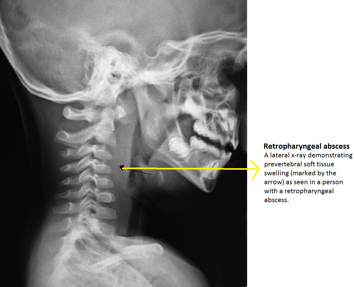 File:Retropharyngeal abscess..png