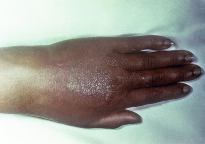 This gonorrhoeae patient presented with gonococcal arthritis of the hand, which caused the hand and wrist to swell due to bacterium Neisseria gonorrhoeae. Adapted from CDC