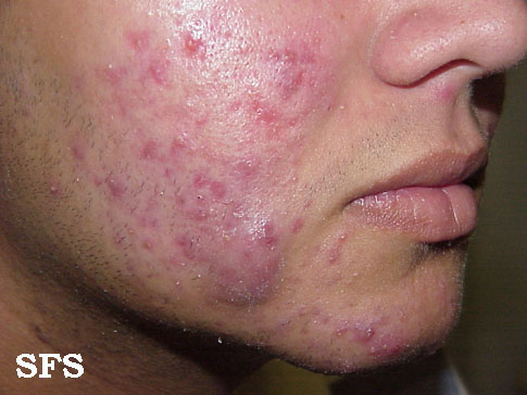 Acne vulgaris. Adapted from Dermatology Atlas[1]