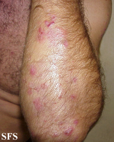 File:Dermatitis herpetiformis17.jpg