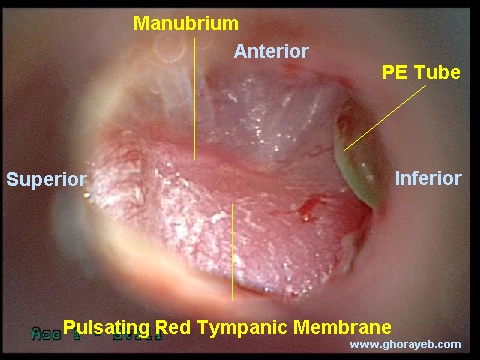 This patient presented with a history of severe bleeding from the placement of a PE tube in her right ear. On examination, the posterior half of the tympanic membrane was red and pulsating[3].