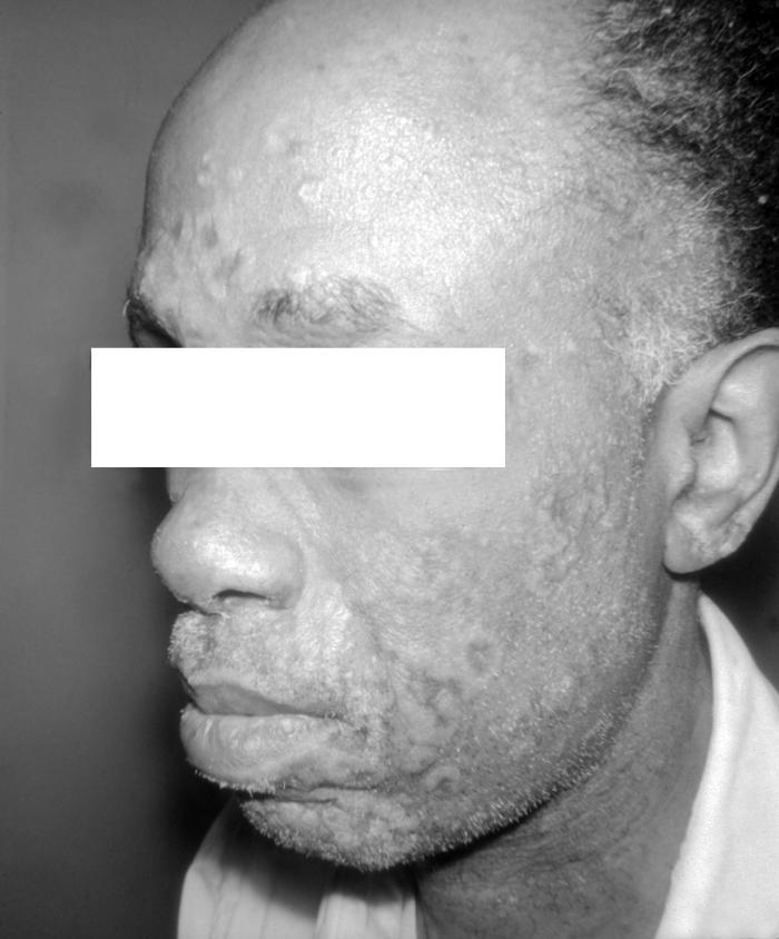 A photograph of secondary syphilitic lesions on a patient’s face. This patient with secondary syphilis has extensive lesions on the face. Secondary syphilis is the most contagious of all the stages, and is characterized by the spread of the bacteria Treponema pallidum, which causes symptoms throughout the body. Adapted from CDC