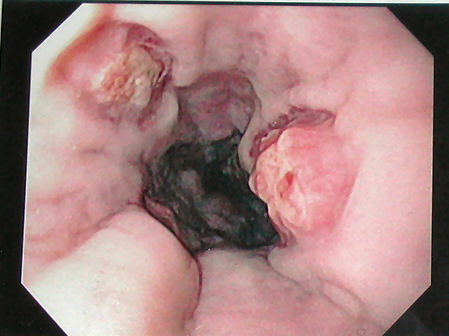 Esophageal varices seven days post banding, showing ulceration at the site of banding.