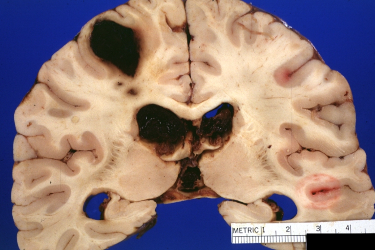 Brain: Lupus Erythematosus Libman Sacks Embolism: Gross fixed tissue one large and two small hemorrhages 19yo female with history of TIAs