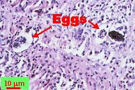 Angiostrongylus costaricensis eggs in intestinal tissue stained with hematoxylin and eosin (H&E). Adapted from CDC