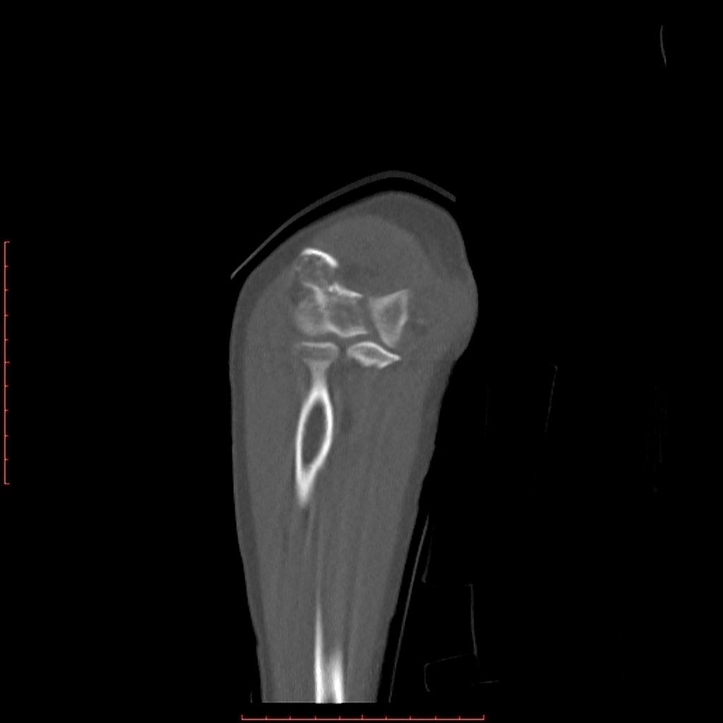 File:Displaced-t-condylar-and-supracondylar-fracture-of-the-distal-humerus (5).jpg