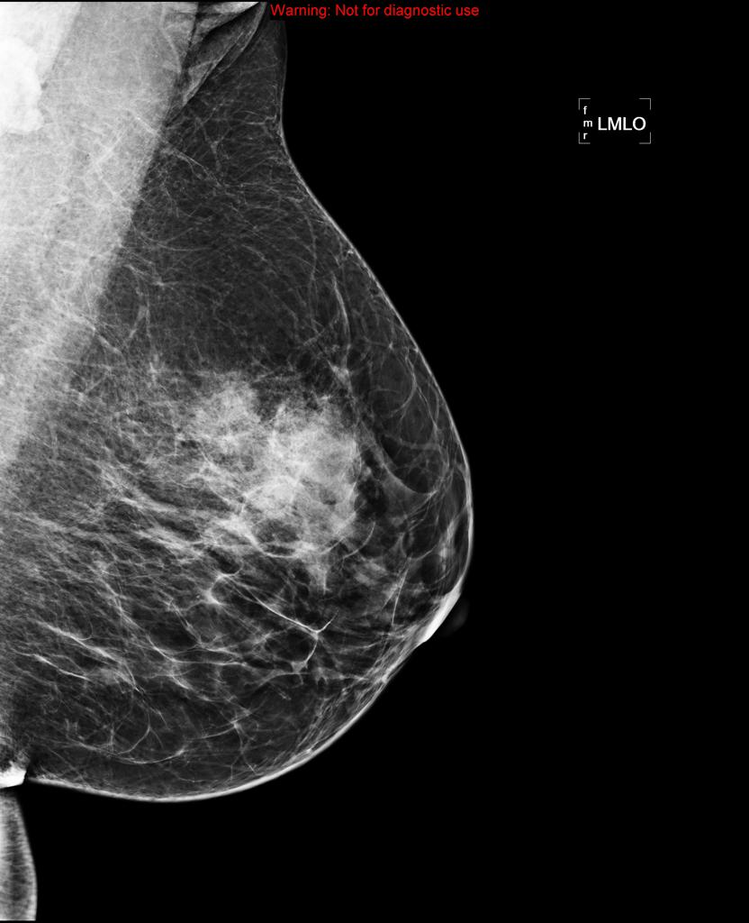 File:Fibroadenoma mammogram 3.jpg