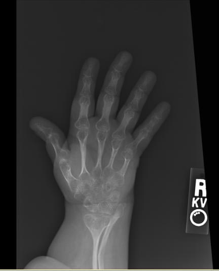 File:Osteogenesis-imperfecta-103.jpg