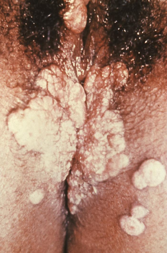 This patient presented with a case of secondary syphilis manifested as perinal wart-like growths. Adapted from CDC