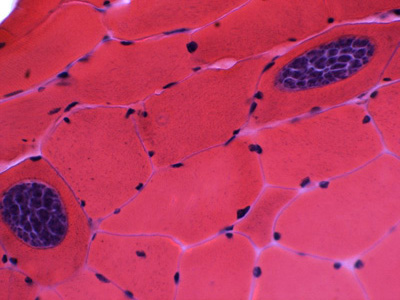 Sarcocysts of Sarcocystis sp. in muscle tissue, stained with hematoxylin and eosin (H&E). Notice the bradyzoites within each sarcocyst. Images courtesy of the William Beaumont Hospital, Royal Oak, MI. Adapted from CDC