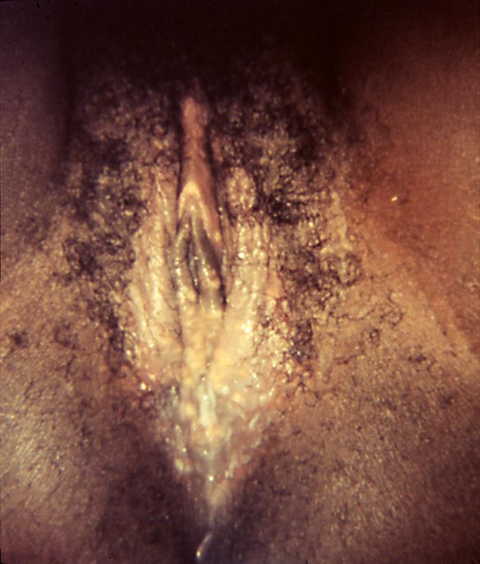 This was an outbreak of herpes genitalis manifested as blistering around the vaginal introitus due to the HSV-2 virus. The sexually transmitted herpes simplex virus type-2 (HSV-2) typically causes one or more blisters to form on, or around the genitals or rectum, which break, leaving tender ulcers that may take 2-4 wks to heal after making their initial appearance. Adapted from CDC