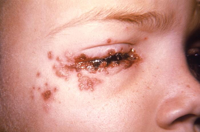 This 7 year old child with a history of recurrent herpes labialis presented with a periocular herpes simplex vesicular outbreak. Herpes simplex virus, otherwise known as Herpesvirus hominis is a member of a group of viruses including those which cause oral herpes (herpes labialis), i.e., usually HSV-1, and genital herpes, i.e., usually HSV-2. Adapted from CDC