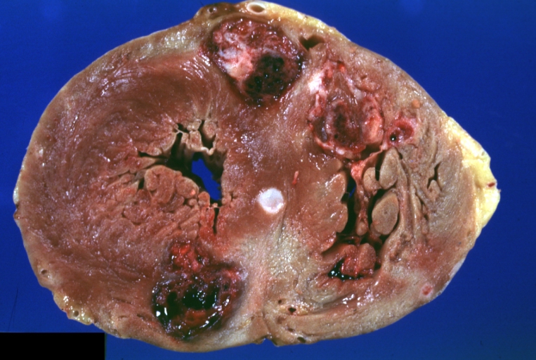 HEART: Metastatic Carcinoma: Gross natural color close-up of horizontal section ventricles with large hemorrhagic lesions (an excellent photo) in large metastatic renal cell carcinoma.