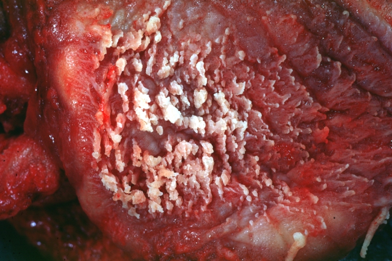 Fibrinous pericarditis: Gross, an excellent example, close-up view of fibrin.