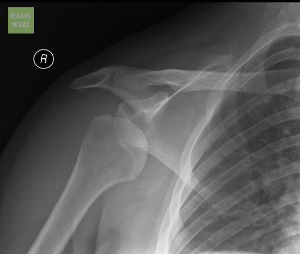 Anterior shoulder dislocation: Dislocation