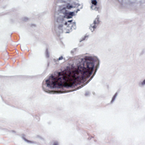 Egg of E. vermicularis in a colon biopsy specimen, stained with H&E. Adapted from CDC